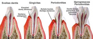 periodontitas
