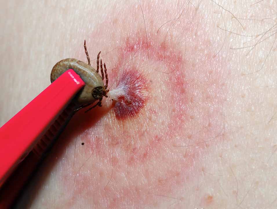tick on skin